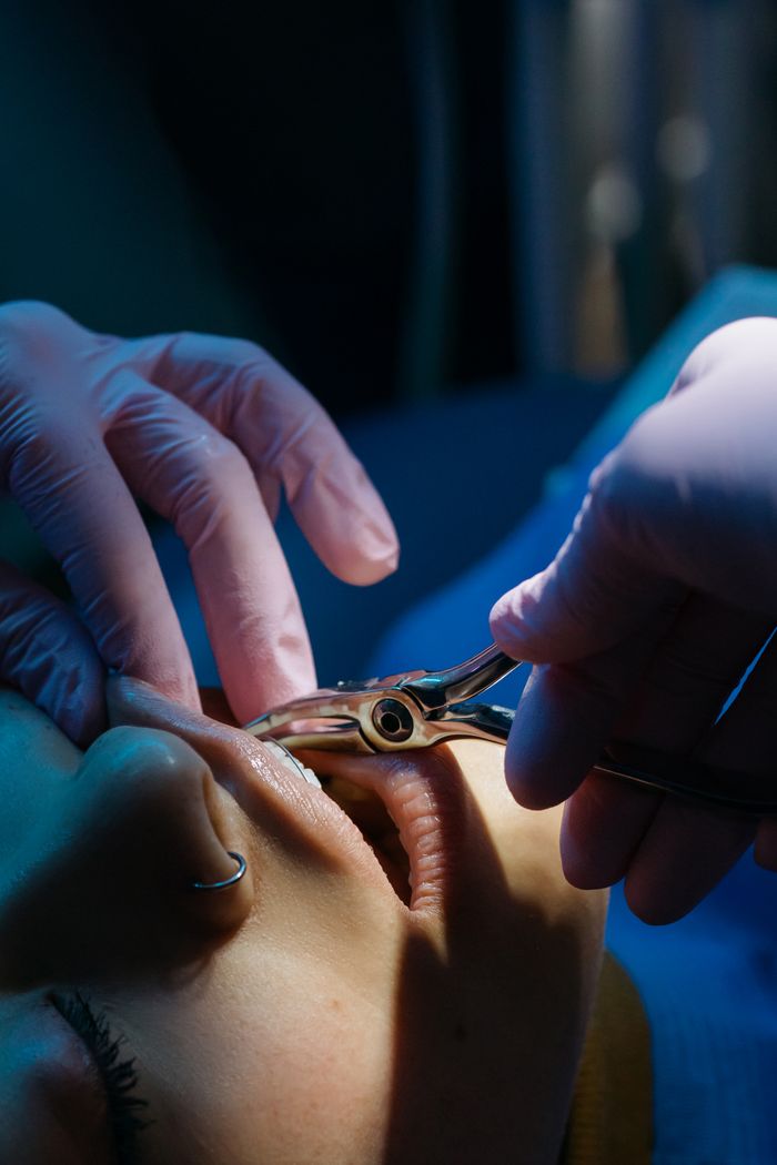 team-03 Detailed close-up of a dental procedure with a patient receiving treatment by a dentist.
